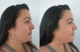 How to Cover a Scab With Makeup