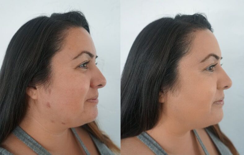 How to Cover a Scab With Makeup
